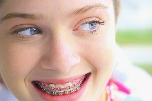 GirlBraces78029090-300x200